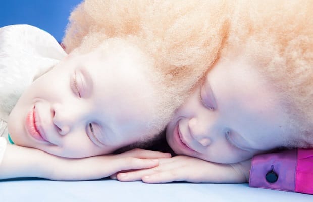 albino twins