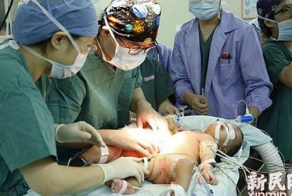 Έγκυος σε σιαμαία είπε «όχι» στην άμβλωση και τώρα τα κρατάει διαχωρισμένα και υγιή στην αγκαλιά της 3