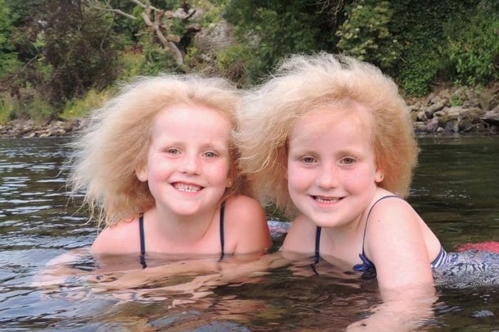 Οι δίδυμες με σπάνια πάθηση μαλλιών! 10 twins hair