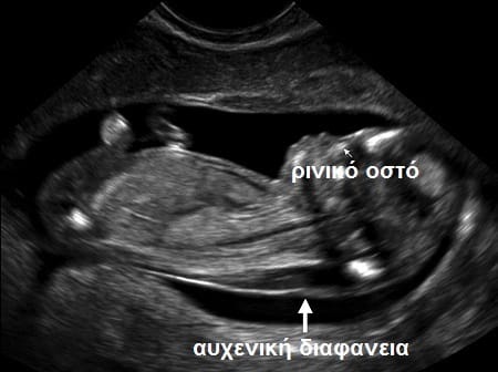 Όλα όσα θέλετε να γνωρίζετε για την αυχενική διαφάνεια και το Σύνδρομο Down 2 nuchal translucency