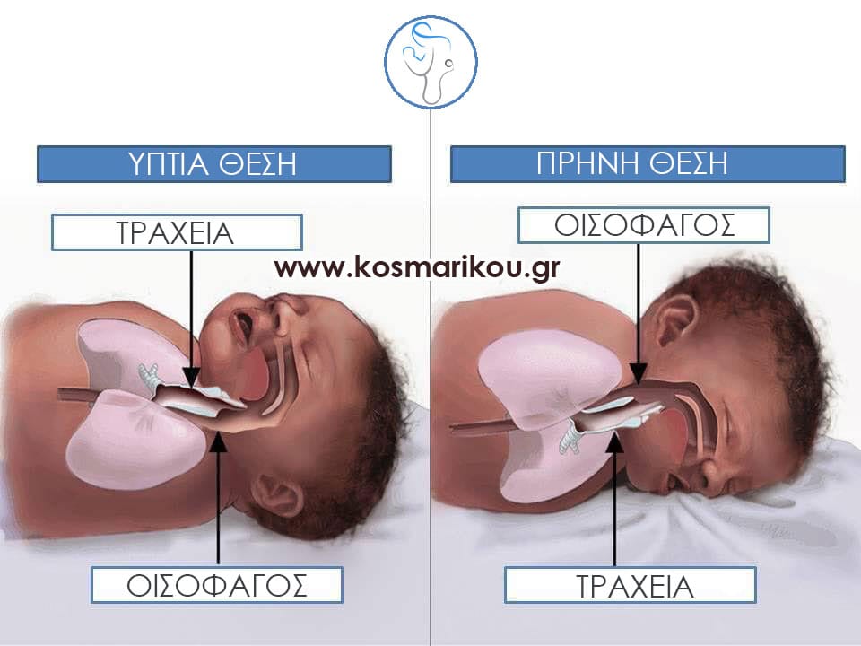 Ύπνος και δίδυμα μωρά: Για πρέπει να κοιμούνται πάντα ανάσκελα - Η παιδίατρος απαντά 