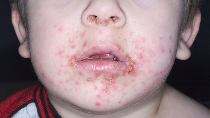 10 Common Questions About Impetigo Answered 722x406 1