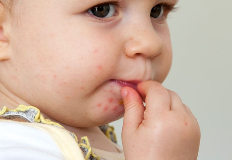 childHFMD 182093379 770x533 1