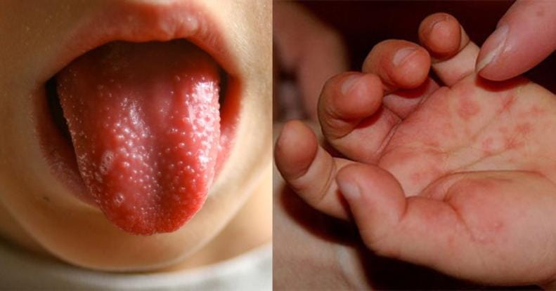 se exarsi o ios koxaki tis teleytaies imeres odigies prolipsis kai antimetopisis 2