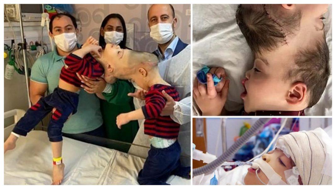 Επιτυχής διαχωρισμός δίδυμων σιαμαίων με ενωμένο εγκέφαλο - Η τρυφερή χειρονομία ύμνος στον δεσμό των διδύμων 2 CT 1068x601 1