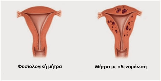 "Όταν διαγνώστηκα με αδενομύωση...φοβήθηκα ότι δεν θα γίνω ποτέ μαμά. Τώρα κρατάω τα διδυμάκια μου...." 1 Αδενομύωση
