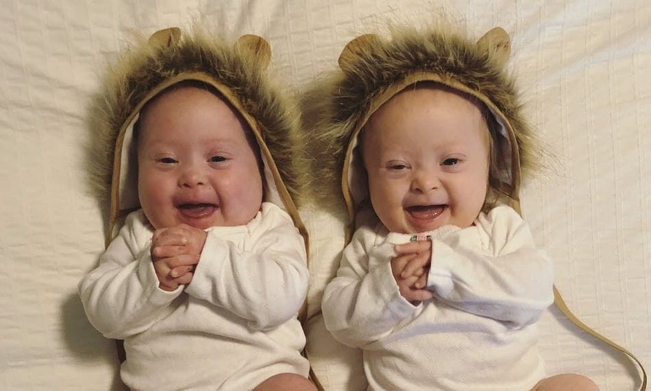 Mom Gives Birth Twins Down Syndrome