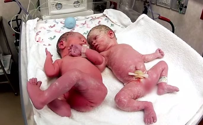 22472617 new born twins
