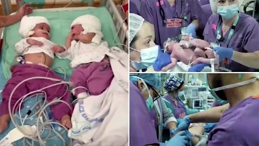 Η συγκινητική στιγμή που σιαμαία δίδυμα ενωμένα στο κεφάλι κοιτάζονται για πρώτη φορά μετά την επέμβαση διαχωρισμού 1 2f4abcd7e74ccb5c1999a641ad72daa7