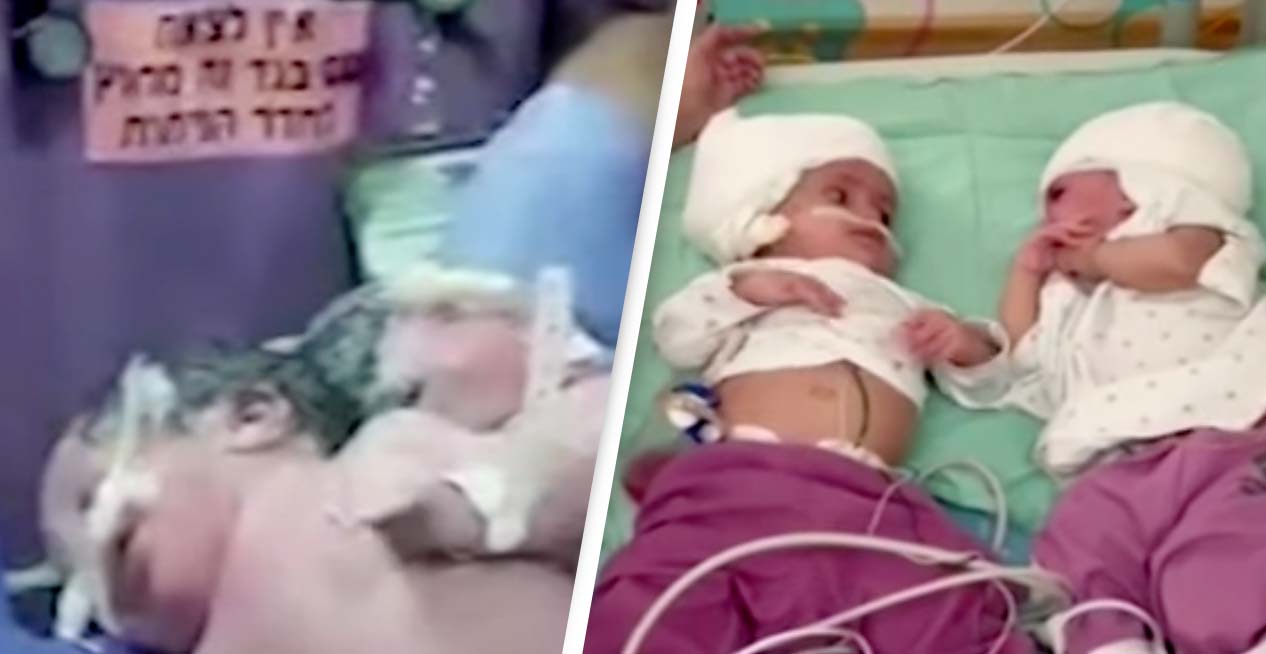 Η συγκινητική στιγμή που σιαμαία δίδυμα ενωμένα στο κεφάλι κοιτάζονται για πρώτη φορά μετά την επέμβαση διαχωρισμού 2 c1
