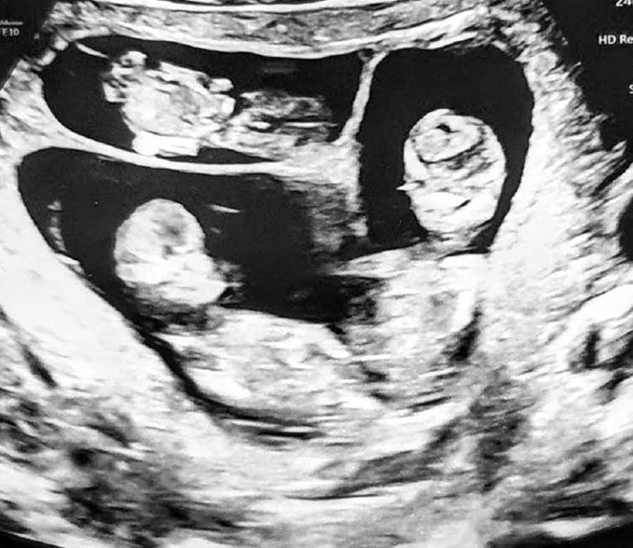 triplet triplets pregnancy abortion juditagota10 900x779 1
