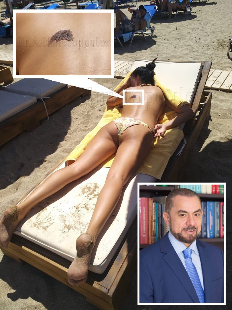 Μελάνωμα: Σωτήρια η έγκαιρη διάγνωση 2 1 19